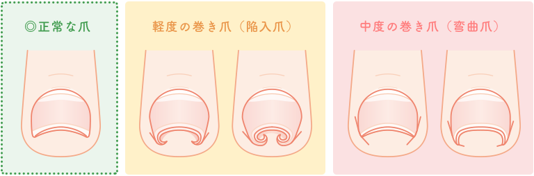 ゆらぎ整骨院の巻き爪治療
