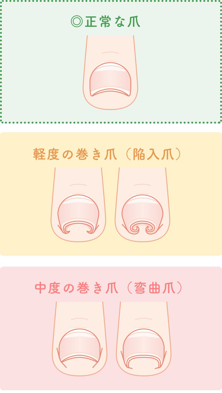 ゆらぎ整骨院の巻き爪治療