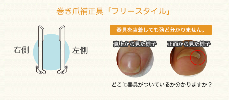 巻き爪補正具「フリースタイル」
