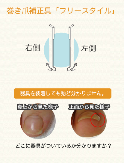 巻き爪補正具「フリースタイル」